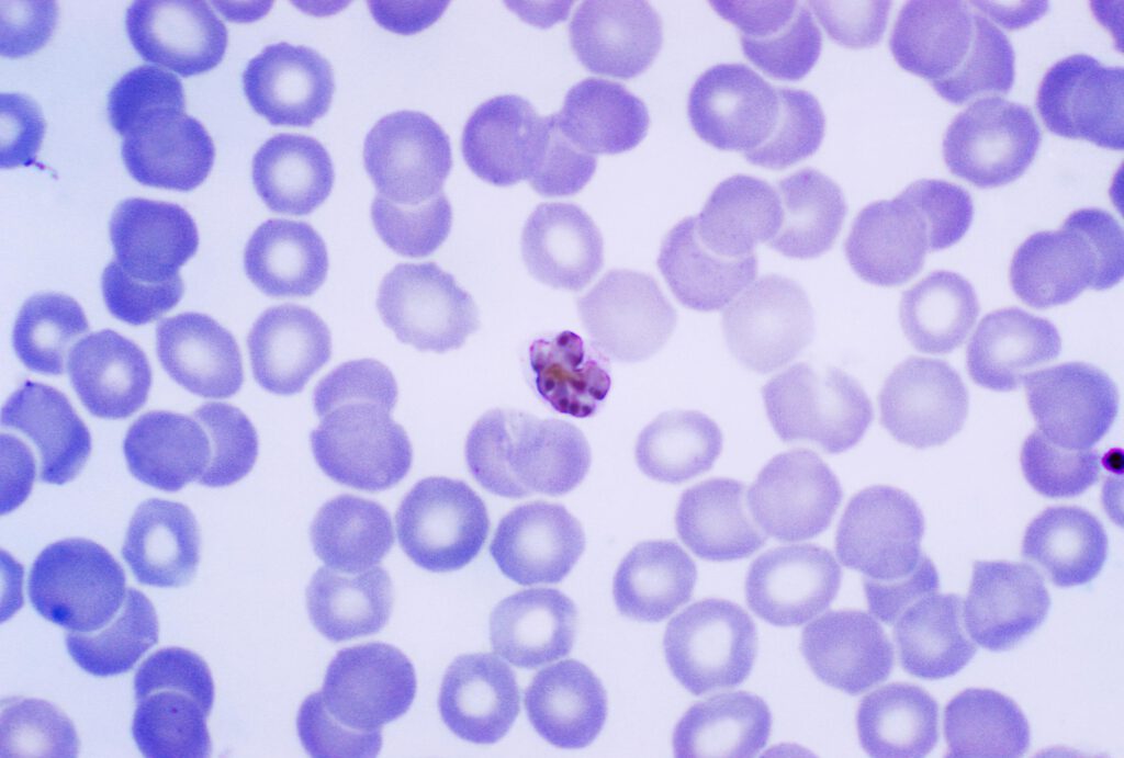 Blood film with malaria infected red blood cells