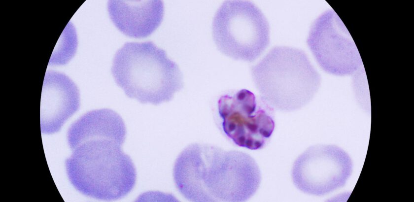 Blood film with malaria infected red blood cells