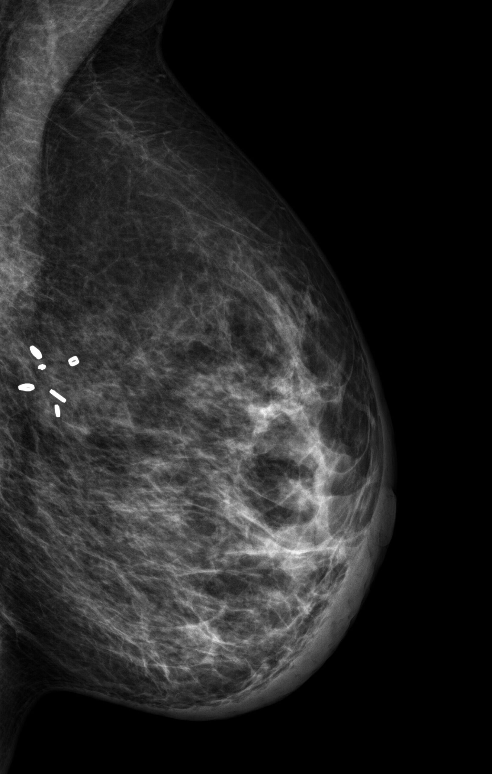 Mammogram with surgical marker