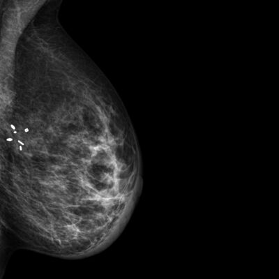 Mammogram with surgical marker